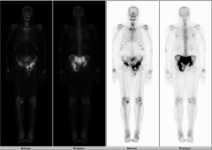 Full body images from a bone scan shows markedly increased radiotracer activity in the pelvis. 