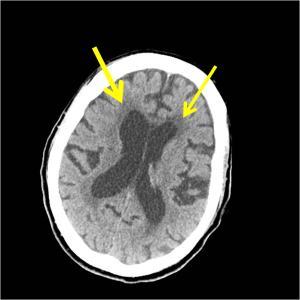 Axial CT scan of the head shows prominent ventricles, widened sulci, and hypoattenuation of the periventricular white matter (yellow arrows). 