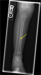 Radiograph of the right tibia and fibula show a non-displaced oblique fracture through the mid diaphysis of the right tibia. 