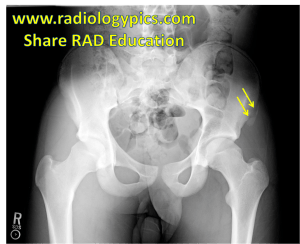 Avulsion fracture: a curvilinear ossific fragment is seen adjacent to the left iliac bone (yellow arrows), compatible with an avulsion fracture of the left anterior superior iliac spine. 
