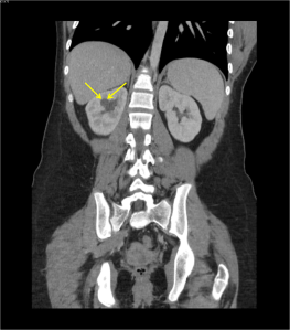 Calyceal diverticulum: Coronal CT of the abdomen and pelvis with contrast reveals a small outpouching in an upper pole calyx of the right kidney (yellow arrows), compatible with a calyceal diverticulum.