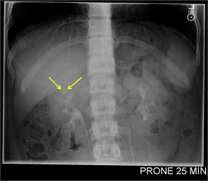 Calyceal diverticulum: prone image from an intravenous pyelogram 25 minutes after intravenous iodine contrast injection reveals a small pooling of contrast in an upper pole calyx in the right kidney, compatible with a calyceal diverticulum.
