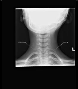 Cervical Ribs: Frontal radiograph of the neck reveals bilateral ribs articulating with the C7 transverse processes. The cervical rib on the left is larger (labeled). 