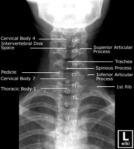 Frontal radiograph of the cervical spine with labels.