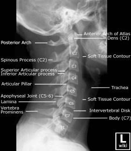 Lateral radiograph of the cervical spine with labels.