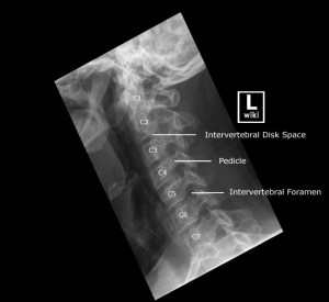 Oblique radiograph of the cervical spine with labels.
