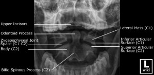 Odontoid view with labels.