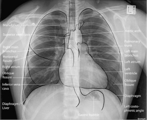 Basic Anatomy to know on a PA chest x-ray.