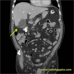 Cholecystitis: Coronal CT of the abdomen and pelvis with intravenous contrast reveals fat stranding surrounding the gallbladder (yellow arrow), compatible with cholecystitis. 