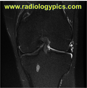 Coronal fluid sensitive MRI of the knee. What are the findings?