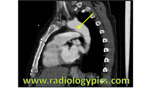 Ductus Diverticulum - Sagittal CT of the chest with intravenous contrast reveals a focal outpouching of the aorta at the aortic isthmus (yellow arrow), representing a ductus bump or ductus diverticulum.