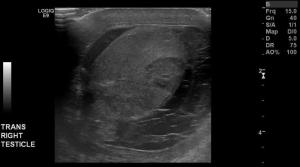 Focal Orchitis with Pyocele: Grayscale scrotal ultrasound image of the right testicle reveals of round heterogenous hypoechoic region in the right testicle, surrounded by fluid with echogenic debris. 