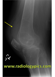 Knee joint effusion - lateral radiograph of the left knee reveals a large joint effusion (yellow arrow).