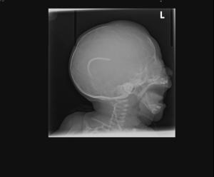 Lateral radiograph of the skull in an infant. What are the findings?