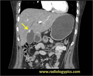 Gallbladder Metastases of Melanoma - Coronal CT of the abdomen with contrast reveals an enhancing soft tissue nodule along the wall of the gallbladder compatible with melanoma metastases.