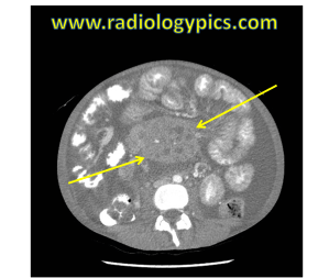 Mesenteric Lymphadenopathy: Axial CT of the abdomen shows a large confluent mass of lymph nodes in the mesentery (between yellow arrows). The hyperdense contrast in the middle of the mass is a "sandwich sign," which is the vessel sandwiched between the mass. As a side note, there is also a large amount of ascites and small bowel wall thickening.