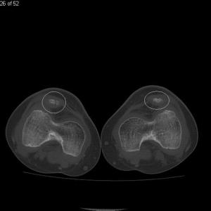 Nail Patella Syndrome: Lower extremity CT shows hypoplastic patella bilaterally, which are also dislocated superolaterally (white circles). 