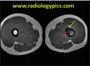 Osteoid Osteoma - Axial T1 weighted MRI of the thighs at the level of the mid femoral diaphysis shows a focal isointense nidus (red arrow) with surrounding cortical thickening (yellow arrow) in the left femoral diaphysis, compatible with an osteoid osteoma. 