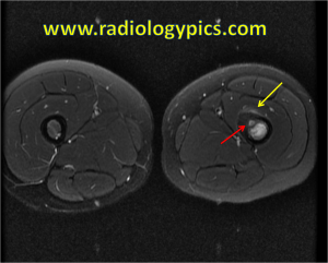 Osteoid osteoma - Axial T2 weighted MRI with fat saturation at the same level reveals the hyperintense nidus (red arrow) with surrounding hyperintense signal (yellow arrow) representing reactive edema in the bone marrow and soft tissues. This is classic for osteoid osteoma. 