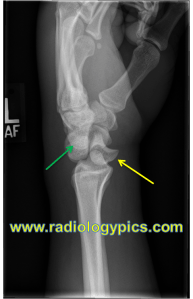 Perilunate dislocation - Lateral radiograph of the wrist reveals proximal and dorsal displacement of the capitate (green arrow) with volar displacement of the lunate (yellow arrow); however, the lunate remains articulated with the radius, indicating this is a perilunate dislocation. 