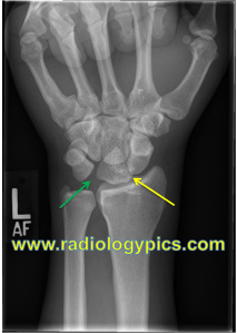 Perilunate Dislocation - Frontal radiograph of the wrist shows a pie shaped lunate (yellow arrow), with widening of the lunotriquetral interval indicating disruption of the lunotriquetral ligament (green arrow). 