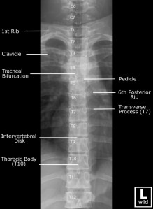 Frontal radiograph of the thoracic spine with labels. 