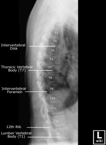 Lateral radiograph of the thoracic spine with labels. 