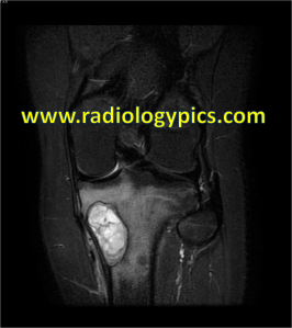 Coronal STIR of the left knee. What are the findings?