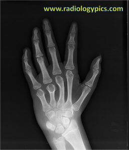 Short 4th and 5th metacarpals: Radiograph of the left hand shows the 4th and 5th metacarpals are abnormally shorter than the other metacarpals. Additionally, the third metacarpal is abnormally bowed. 