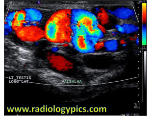 Doppler color ultrasound through the left scrotum with valsalva. What is your diagnosis?
