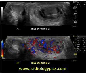 Epididymitis: Grayscale ultrasound through the scrotum reveals asymmetric swelling and hypoechogenicity of the left testicle and epididymis. Doppler color ultrasound reveals increased flow to the left testis and epididymis, compatible with epididymitis-orchitis. 