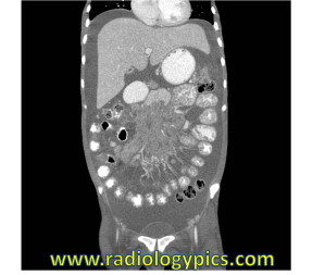Coronal CT of the abdomen and pelvis with intravenous and oral contrast. What are the findings?