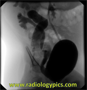 Oblique image from a retrograde voiding cystourethrogram. What are the findings?