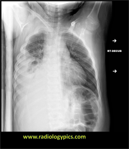 Empyema (loculated pleural effusion): right lateral decubitus radiograph shows a right sided pleural effusion which does not flow freely to the dependent portions of the chest indicating a loculated pleural effusion, or empyema. 
