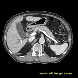 Axial CT of the abdomen with contrast. What are the findings?