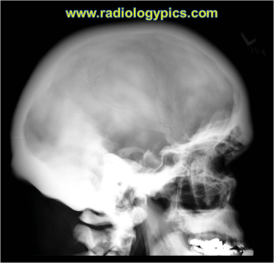 Lateral radiograph of the skull. What is the abnormality?