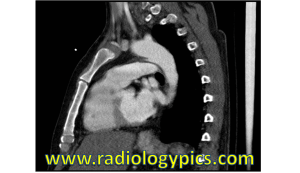 Sagittal CT scan of the chest with intravenous contrast. What are the findings?