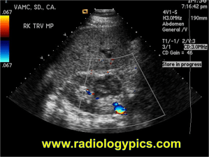 Multilocular Cystic Nephroma:  Doppler color ultrasound of the midpole of the right kidney reveals a lobulated and multiseptated hypoechoic mass, which is typical for a multilocular cystic nephroma; however, not specific. 
