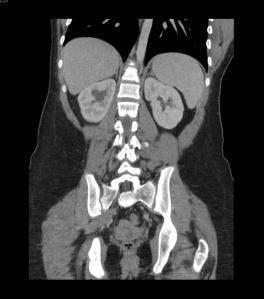 Coronal CT of the abdomen and pelvis with intravenous contrast. Identify the salient abnormality. 