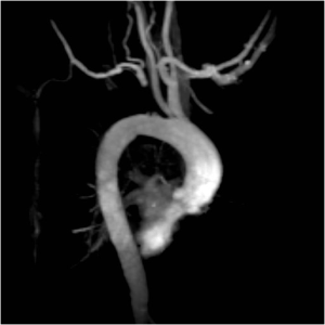 Oblique MR angiogram of the aorta and neck vessels. 