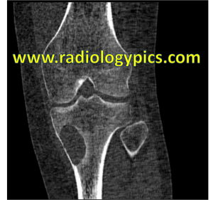 Coronal CT of the left knee. What are the findings?