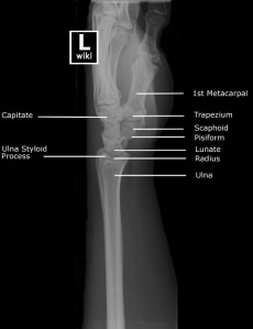 Lateral Radiograph of the Wrist with Labels. 