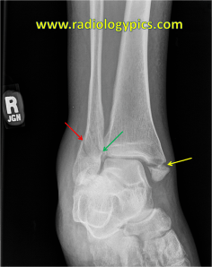Lauge Hansen SER IV - Ankle mortise view shows fracture of the medial malleolus (yellow arrow) and a spiral fracture of the lateral malleolus (red arrow) which extends to the medial cortex of the fibula (green arrow). This is a Lauge Hansen supination external rotation type IV injury (the posterior malleolus fracture was noted on the lateral view). 