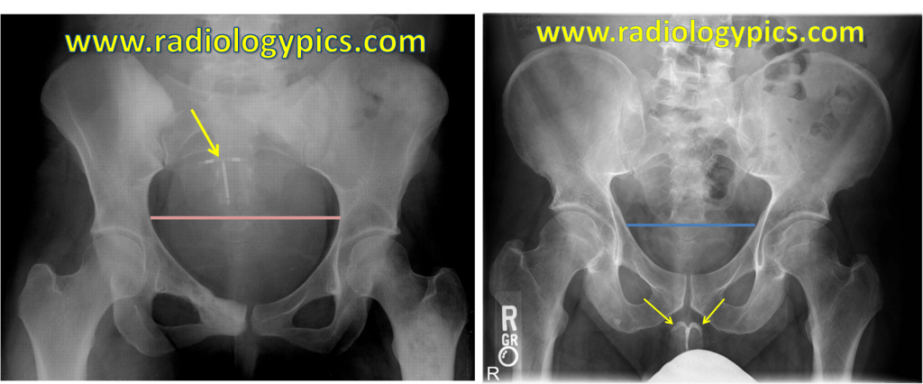 The Differences Between the Male and Female&nbsp;Pelvis
