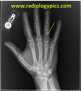 Enchondroma - frontal radiograph of the right hand reveals a lytic lesion in the fourth proximal phalanx (yellow arrow) with subtle areas of calcified matrix within the lesion compatible with an enchondroma.