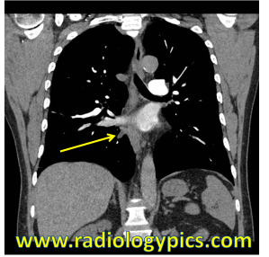 Esophageal Bronchus - Coronal CT of the chest with intravenous contrast reveals an abnormal bronchus arising from the distal esophagus feeding the medial basal segment of the right lower lobe. 