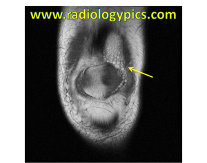 Lipohemarthrosis - Coronal T1 weighted image of the knee reveals numerous fat droplets (yellow arrow) floating to the non-dependent portion of the patient's knee around the patella.