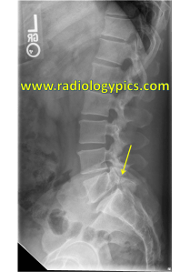 Pars defects - lateral radiograph of the lumbosacral spine reveals a pars interarticularis defect at L5-S1, with anterolisthesis of L5 on S1. This is also referred to as spondylolysis with spondylolisthesis.