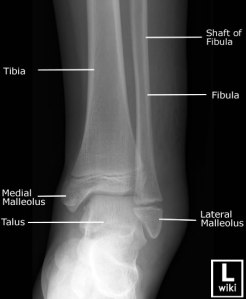 AP radiograph of the pediatric ankle with labeled anatomy. 