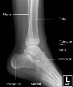 Lateral radiograph of the pediatric ankle with labeled anatomy. 